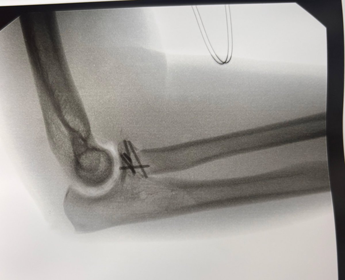 M_Helm816's tweet photo. Finals followed by LUCL repair with internal brace augmentation. Stable elbow ✅ https://t.co/Pz4Vw0G2rG