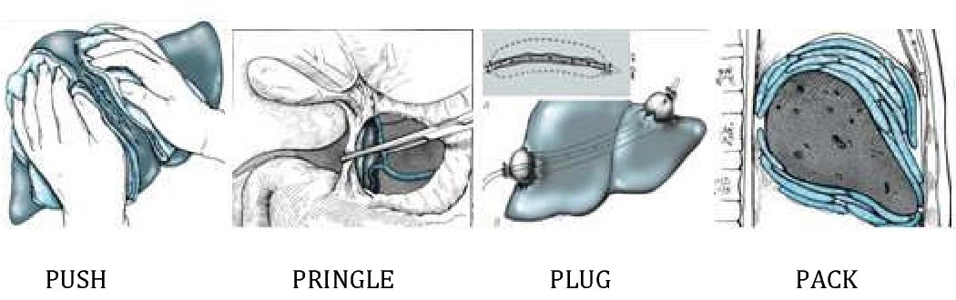 PipeCabreraV's tweet photo. Management of severe liver injuries: push, pack, pringle – and plug! @pferrada1 @TomVargheseJr @SWexner @CiruAndes2 https://t.co/Bs0d0W9OFS