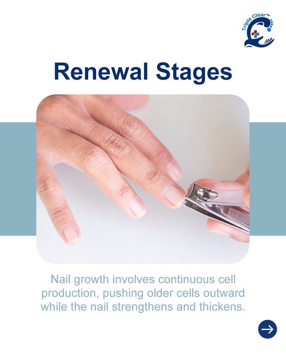 TripleClearHF's tweet image. Nails grow from the matrix beneath the cuticle.

When fungus or damage interferes, results take time.

Triple Clear HF treats problem areas and protects new growth as healthier cells replace the old.

Buy yours at TripleClearHF.com

#TripleClearHF #NaturalNails