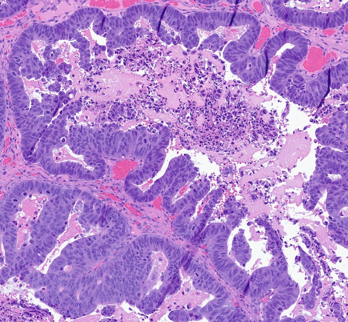 You don't even need immunostains to tell where this brain tumor originally came from. (Reach into the BOWELS of your knowledge base to come up with the answer.) #pathology #neuropath #pathtwitter