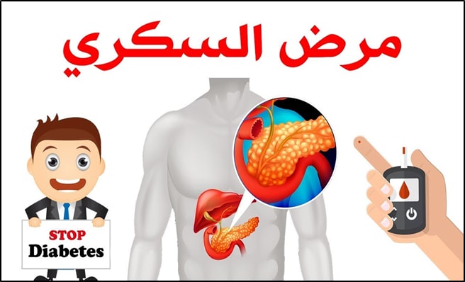 مـرض السكــري :~

مرض السكري هو حالة مزمنة تؤثر في كيفية استهلاك الجسم للسكر (الجلوكوز) للحصول على الطاقة.

الجلوكوز ضروري جداً للدماغ والخلايا، لكن زيادته في الدم دون انتقالها للخلايا تسبب مشاكل صحية.