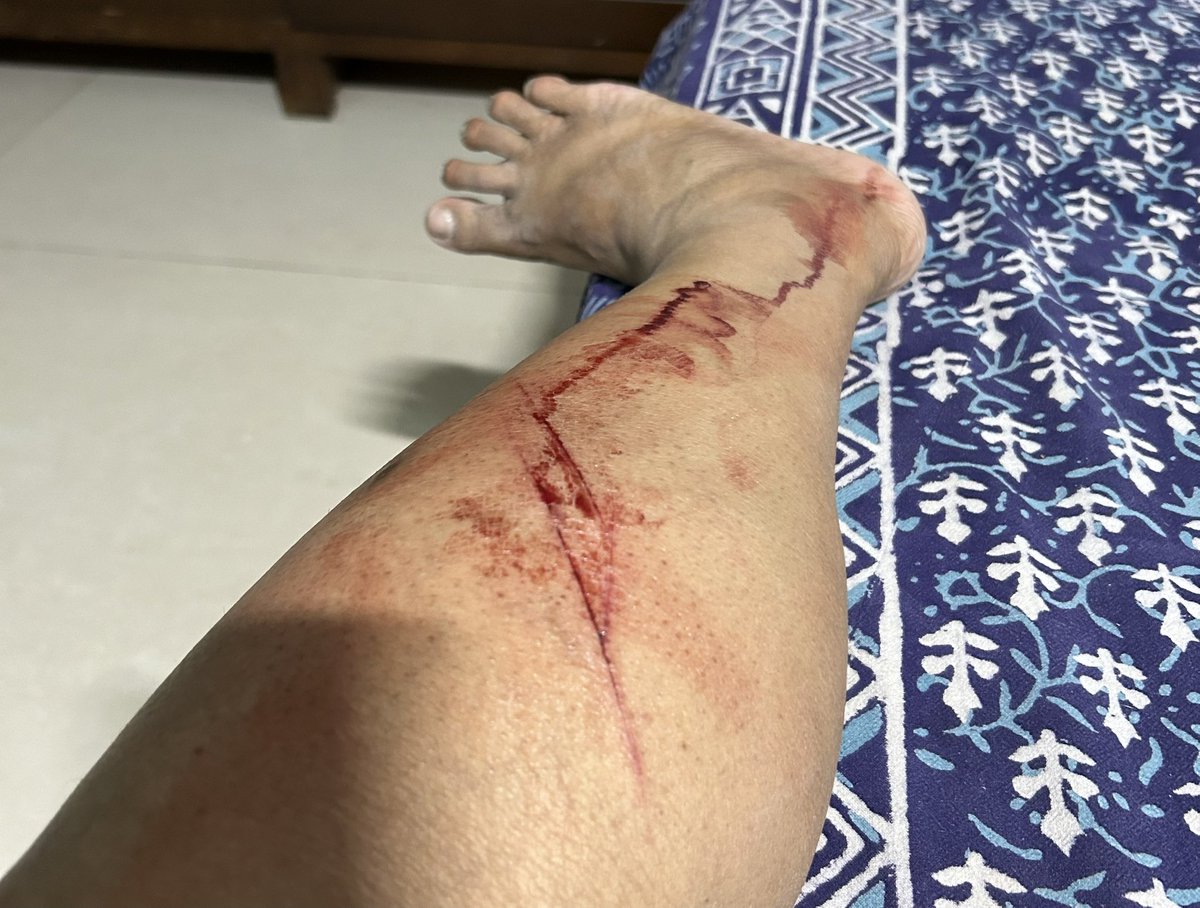 Kaabeing's tweet photo. This is routine !  I am from Pune , beaten and attacked at a feeding point allocation meeting in the presence of PMC  and spca  officers. Police shrugged it off as a “kutta -billi” matter . Every dog I feed is sterilised, vaccinated, dewormed, flea medicated and friendly. https://t.co/GTkaYqwX0P