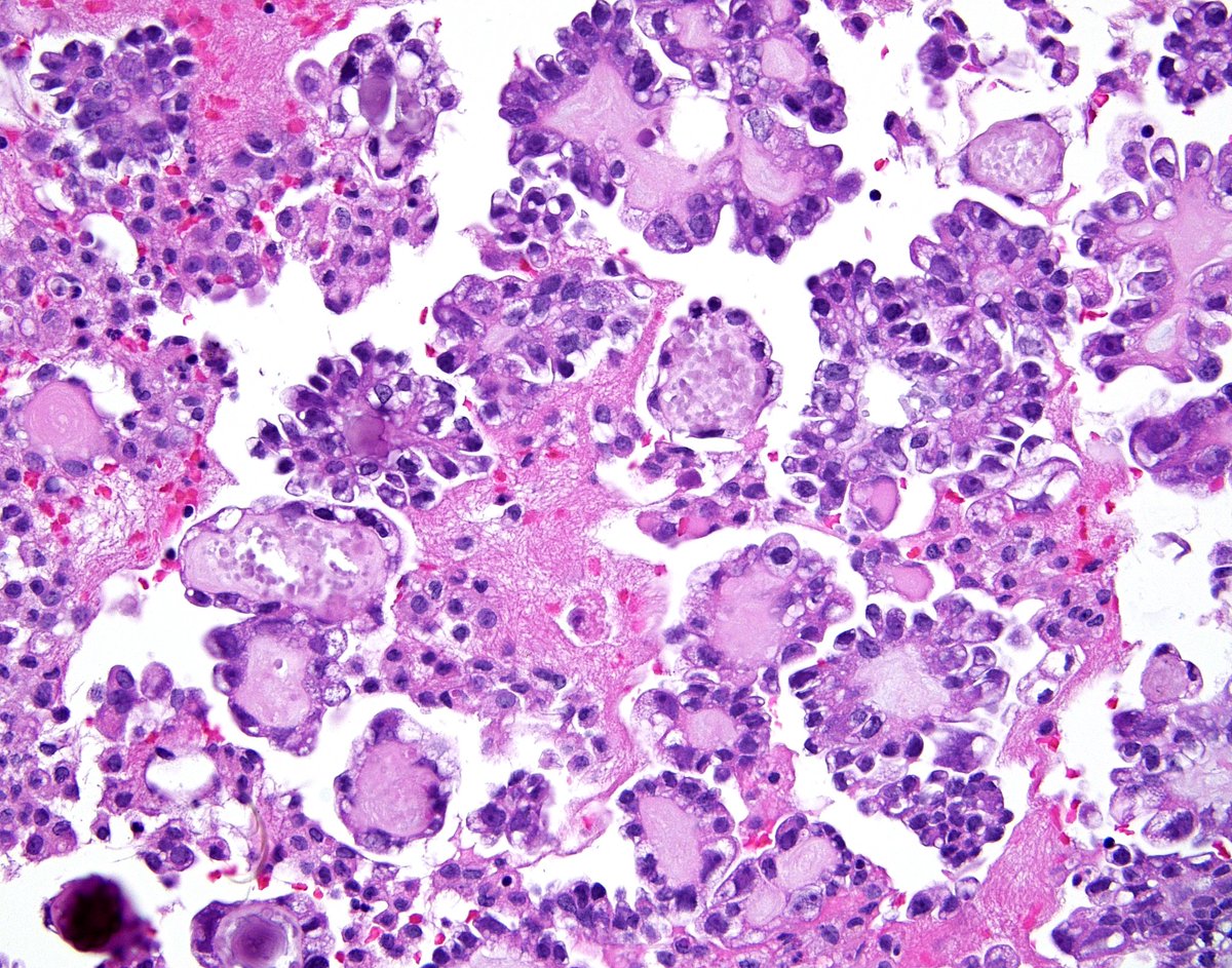All the ingredients in this pleural fluid cell block for the diagnosis of a "Clear Cell Carcinoma" metastatic from the patient's known ovarian primary - hobnailed nuclei, globular structures with hyaline-type matrix, psammoma bodies and so called "raspberry bodies".
See the