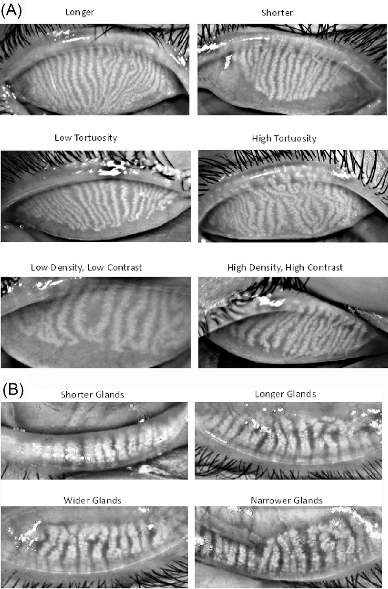 NatEyeInstitute's tweet photo. What’s “normal” for eyelid oil glands? New AI-powered research shows Meibomian gland appearance varies by age &amp; ethnicity but not sex or contact lens use. Findings may help detect early signs of dry eye.  

https://t.co/z1dnUl8yfo

#NIHFunded #ResearchNews #VisionResearch https://t.co/NtMh43N6bR