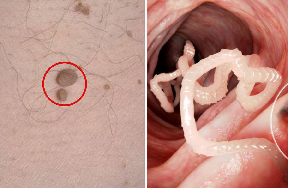 Humanbydesign3's tweet image. #Papillomas are the first sign that you are being eaten alive by #parasites!

If you find #neoplasms on your skin - 99% of the time you have #worms and ascarids in your body!
And this is 100% true!