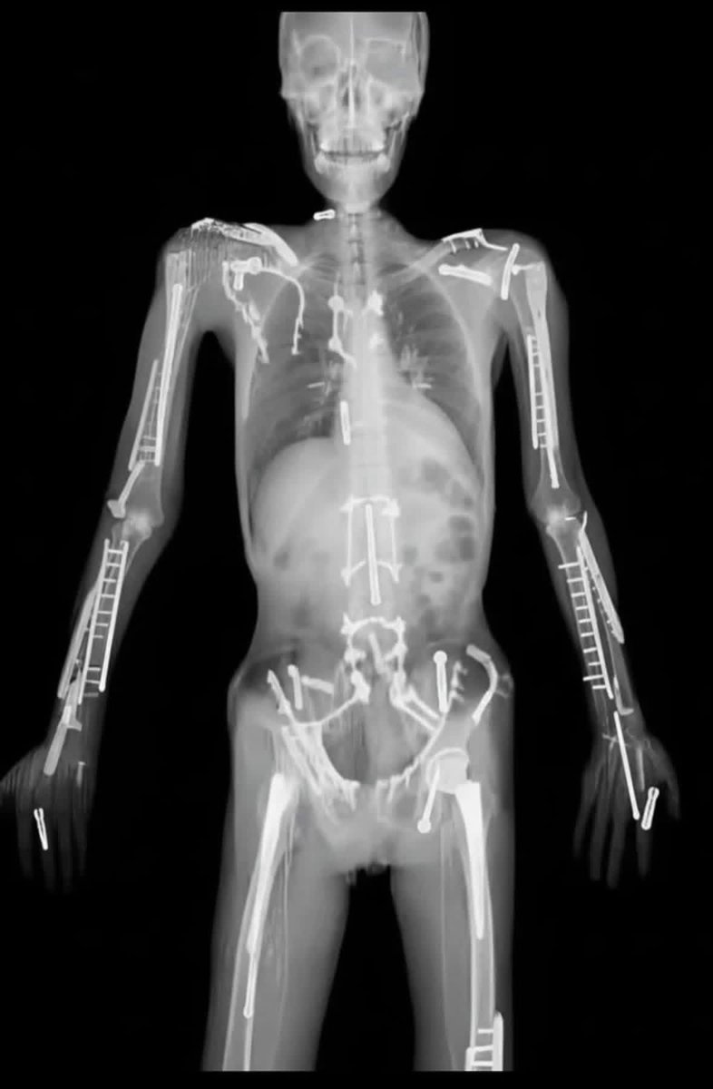 hemo_shk's tweet image. #Xray

X-ray tells the story

What happened?!
 
#MEDHM #MedX @IhabFathiSulima