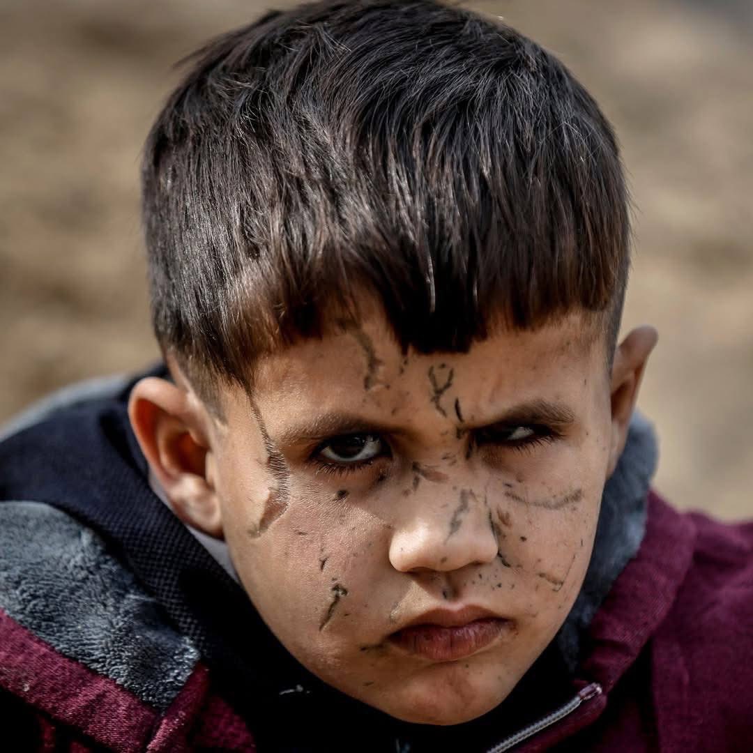 Emeliarjl's tweet image. Unseen tears... Behind these scars lie a billion bombs and the suffering in Gaza caused by the terrorist Israeli occupation, supported by terrorist America.