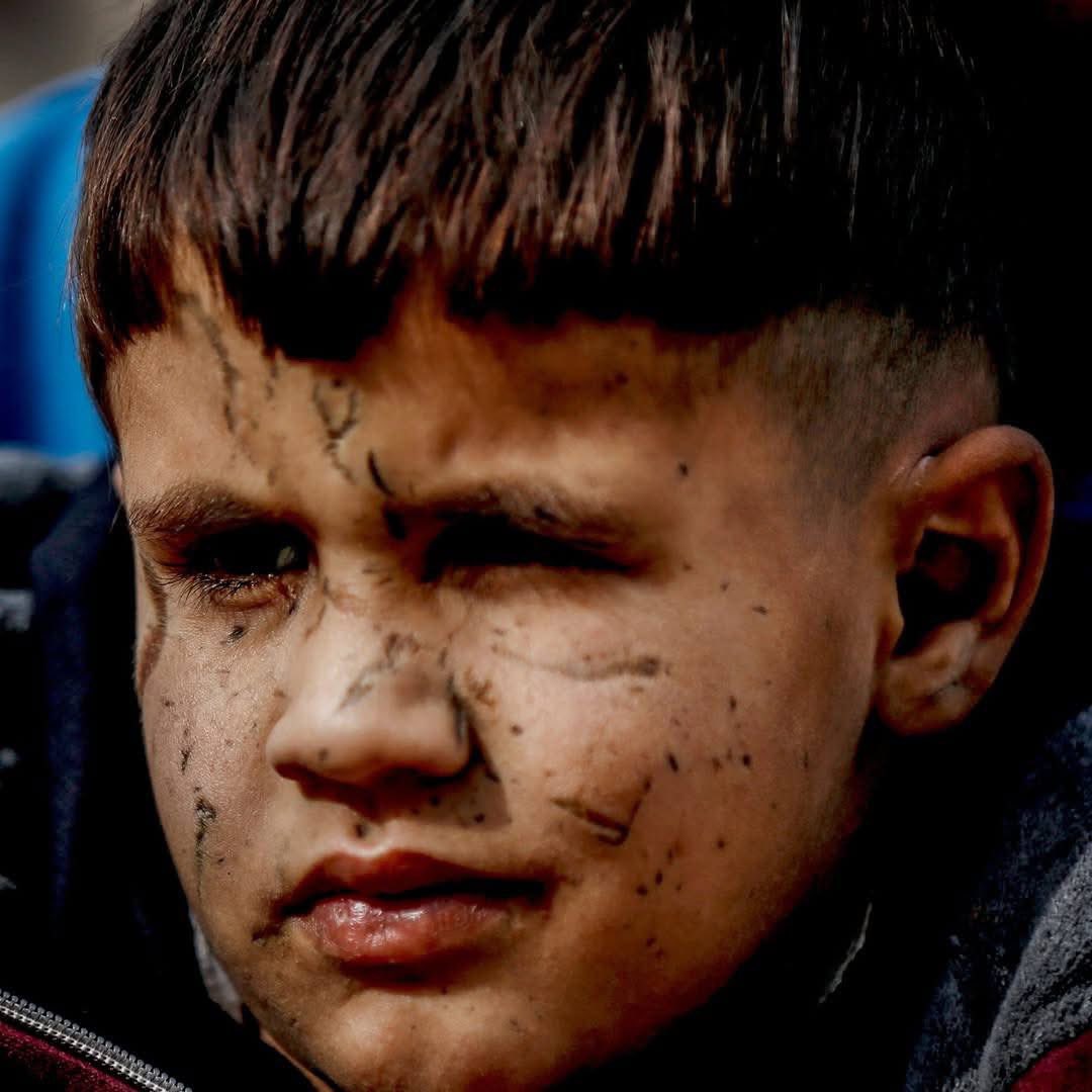 Emeliarjl's tweet image. Unseen tears... Behind these scars lie a billion bombs and the suffering in Gaza caused by the terrorist Israeli occupation, supported by terrorist America.
