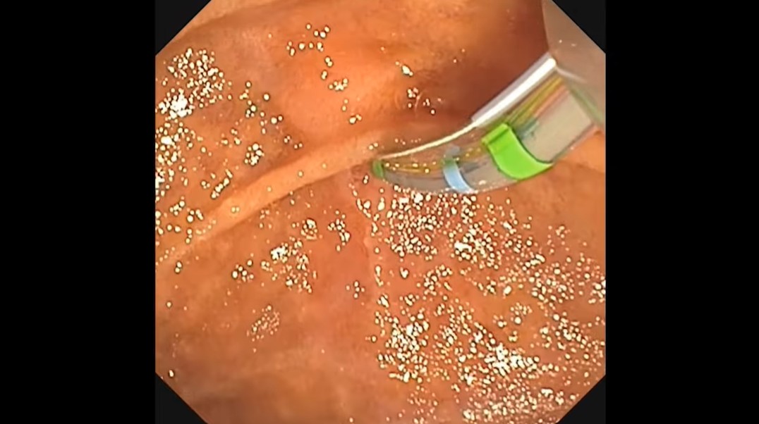 VideoGIE Journal tweet media