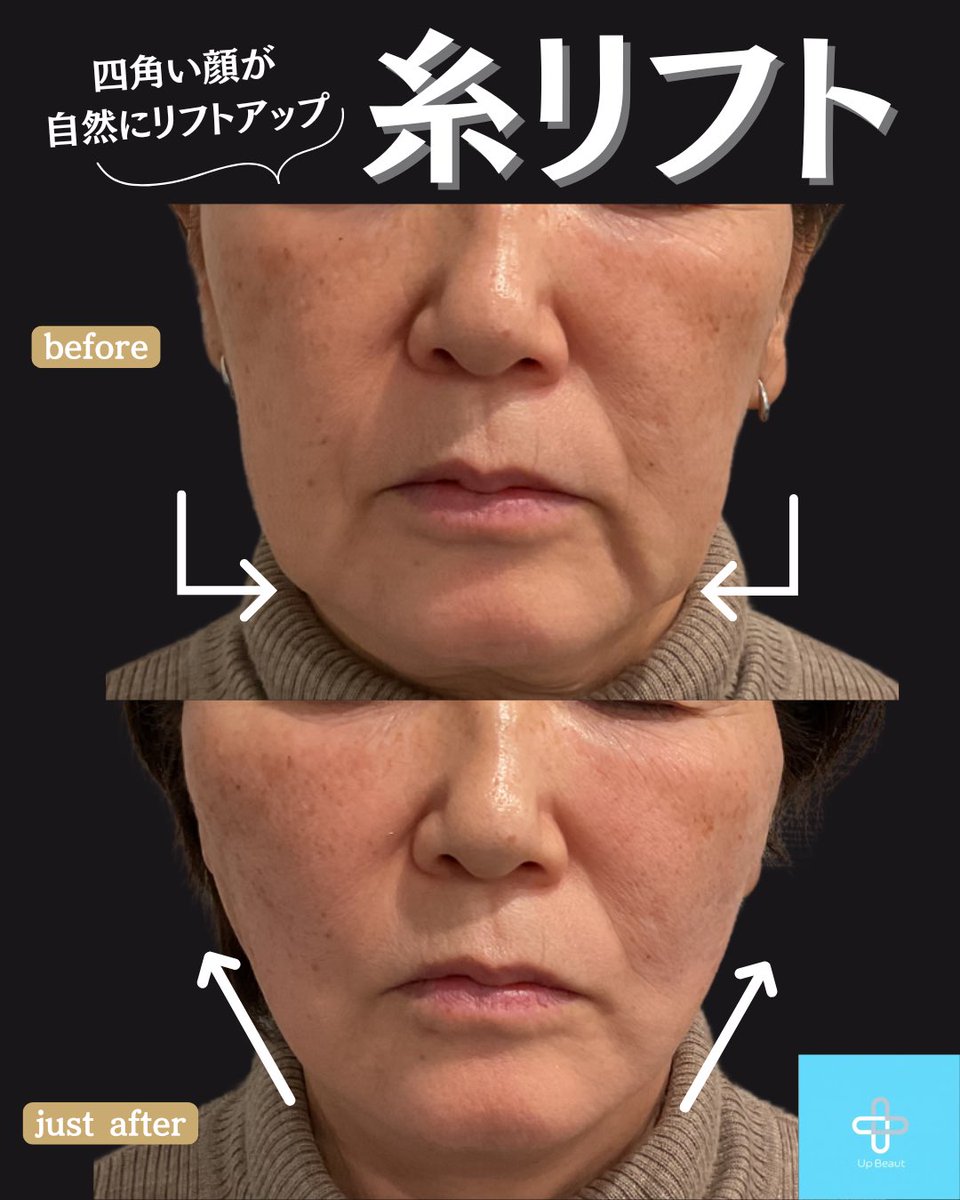 四角い顔を自然にリフトアップ⤴️✨ 👩‍⚕️担当医：久保院長 💉施術