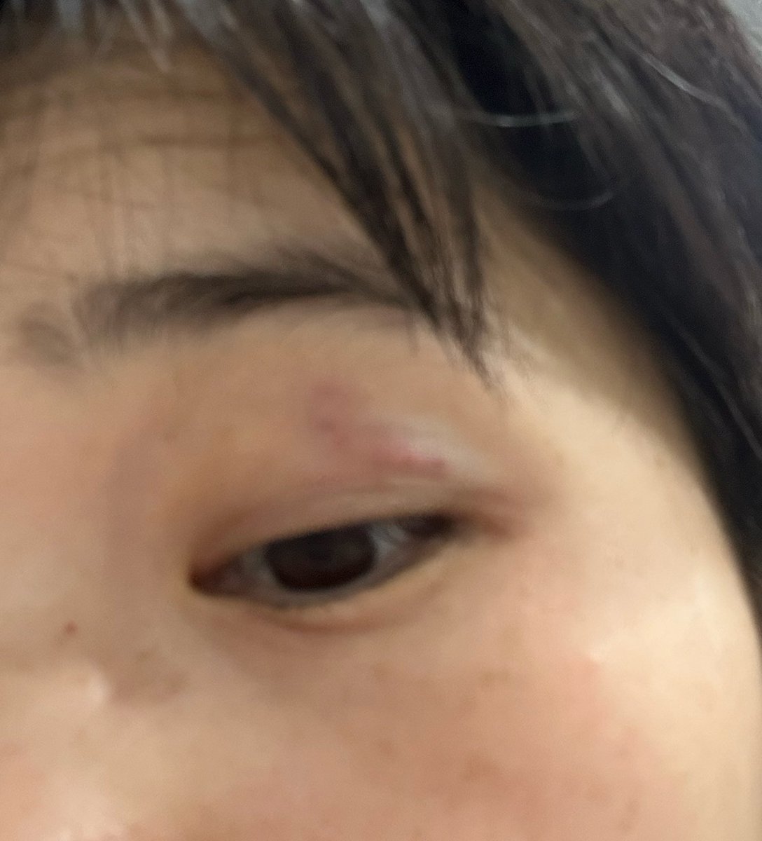 오랜만에 나만큼 커진 중학생친구와 스파링 ㅋㅋㅋㅋ 팔에 그친구의 피가 튀어잇고 나는 눈탱이를 내줌