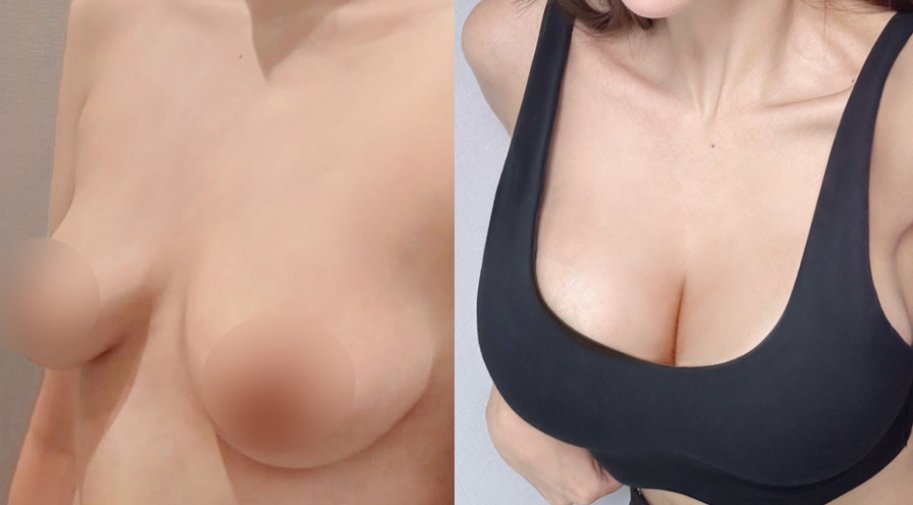 韓国豊胸No.1♥NANA美容外科♥ 👶授乳後に 「胸がしぼんだ」「ハリが