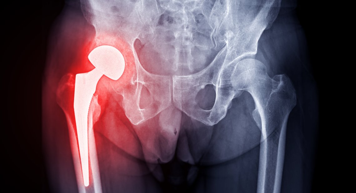 IREC_Energia's tweet image. 🩺@IREC_Energia participa en el projecte #PROSAFE, amb @LenzInstruments, per desenvolupar una nova solució diagnòstica basada en espectroscòpia Raman per identificar els organismes responsables d’infeccions protètiques.  

🔗irec.cat/ca/press-socie… 

#IRECprojects #PROSAFE