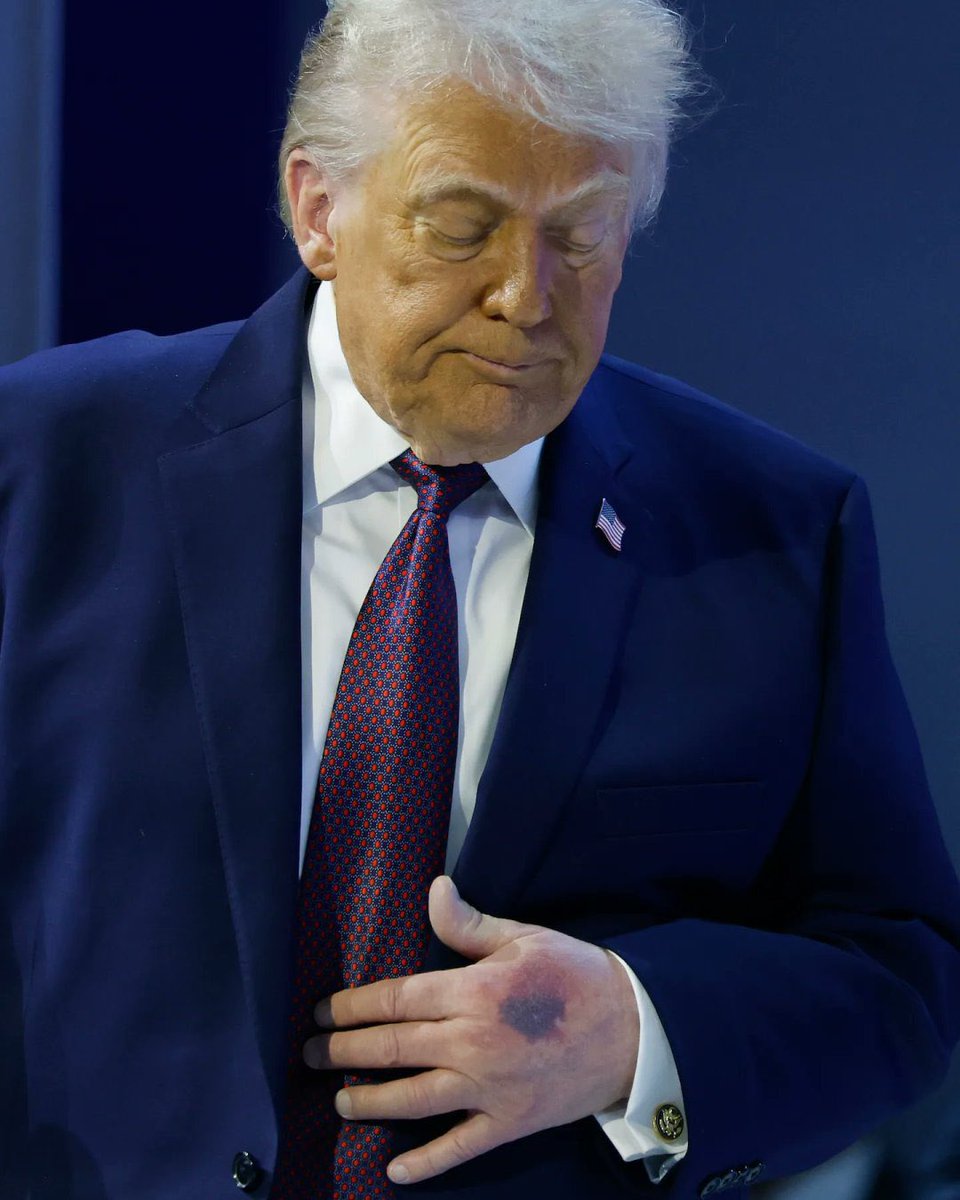 DidDTrumpDie's tweet image. The fragility is obvious now. It won’t be long