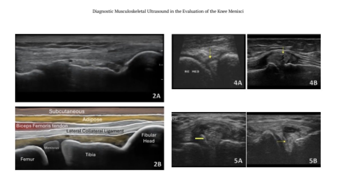 Robptatcscs's tweet photo. New manuscript published this month in #IJSPT https://t.co/TmJx3FjtBA
