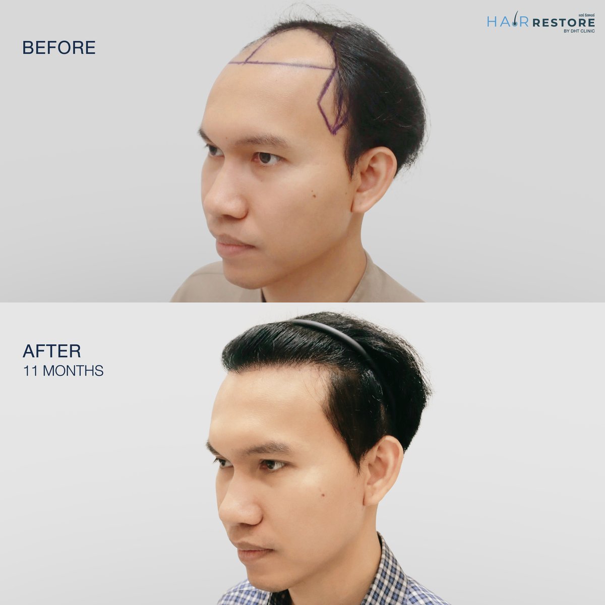 dhtluxclinic's tweet photo. Mr. J’s hair transplant result in just 11 months ✨
More confidence, ready to look his best on his wedding day 💕
With #AdvanceFUT non-shaven technique for natural results and fast recovery.
#HairTransplant #AdvanceFUT #NonShavenHairTransplant #HairRestoration https://t.co/rFYRbMPB0k