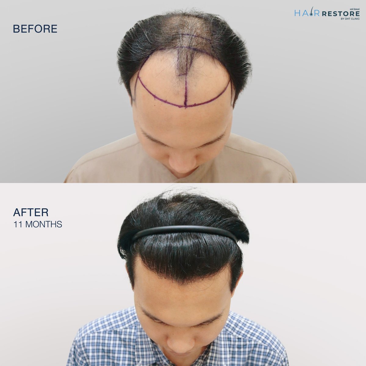 dhtluxclinic's tweet photo. Mr. J’s hair transplant result in just 11 months ✨
More confidence, ready to look his best on his wedding day 💕
With #AdvanceFUT non-shaven technique for natural results and fast recovery.
#HairTransplant #AdvanceFUT #NonShavenHairTransplant #HairRestoration https://t.co/rFYRbMPB0k