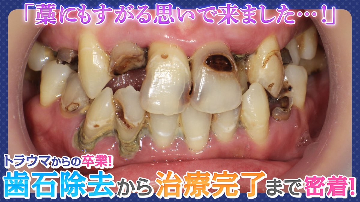 yukithewhite's tweet photo. 虫歯が多すぎて手遅れかも…と感じている方へ
当院には、そうした悩みを抱えた方が多く来院されています。

初回から仮歯で見た目を整え、1回で複数本治療も可能✨
どんな状態でも「できる治療」を一緒に探します。

永山の���いと技術が詰まった新作動画、ぜひご覧ください🎥

https://t.co/KMZCgdz8LY https://t.co/DYYQ4y9Rmt