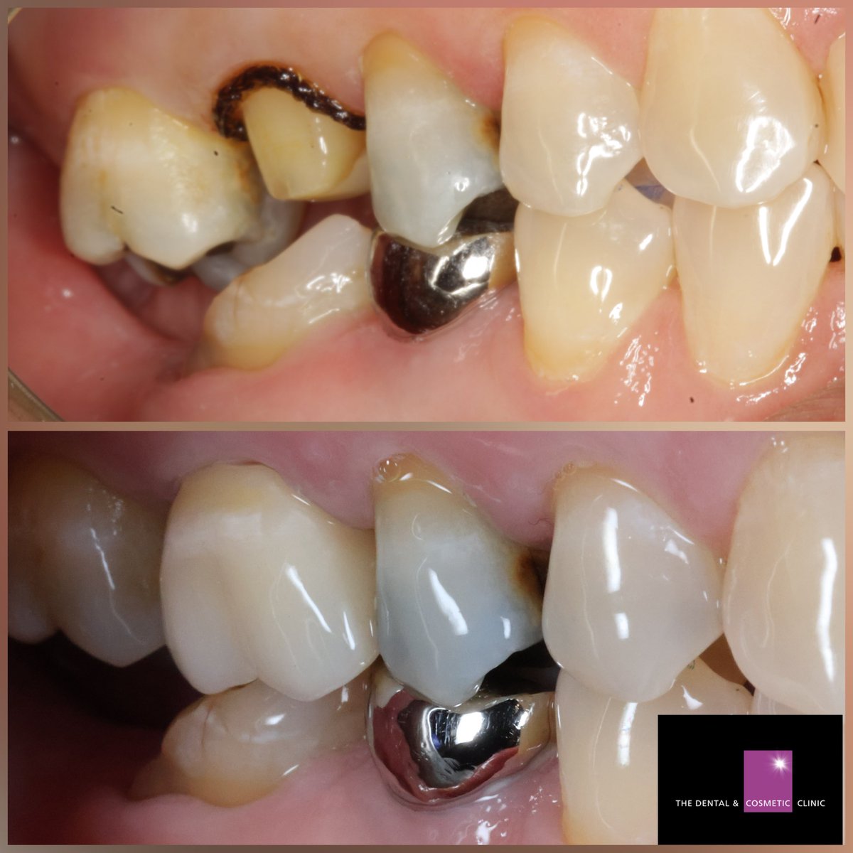 It can be very tricky to match single crowns with multiple shades occurring in the surrounding teeth. The masterful @194dental_lab did just that here for an upper molar crown!
Drop us a DM 📲
visit our website 💻 
or call us on 0116 278 5611 📞 
dentalandcosmeticclinic.co.uk/treatment/crown