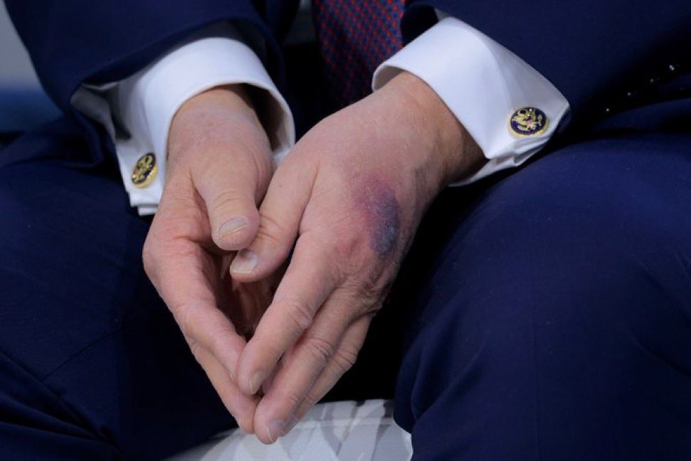 LucasSa56947288's tweet image. LOOK - Donald Trump's *left* hand -- not the one that is disfigured -- it now shows a large bruise and is very discolored 

These pictures were from today in Davos and are via Chip Somodevilla (Getty) and Fabrice Coffrini (AFP)