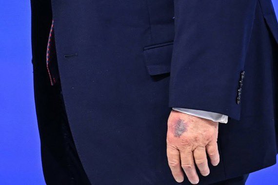 LucasSa56947288's tweet image. LOOK - Donald Trump's *left* hand -- not the one that is disfigured -- it now shows a large bruise and is very discolored 

These pictures were from today in Davos and are via Chip Somodevilla (Getty) and Fabrice Coffrini (AFP)