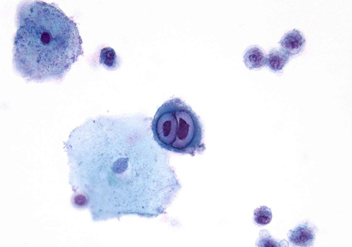 "Eyes without a face ...." (Billy Idol).
Cowdry Type A bodies in HSV. (GYN PAP Test, ThinPrep)