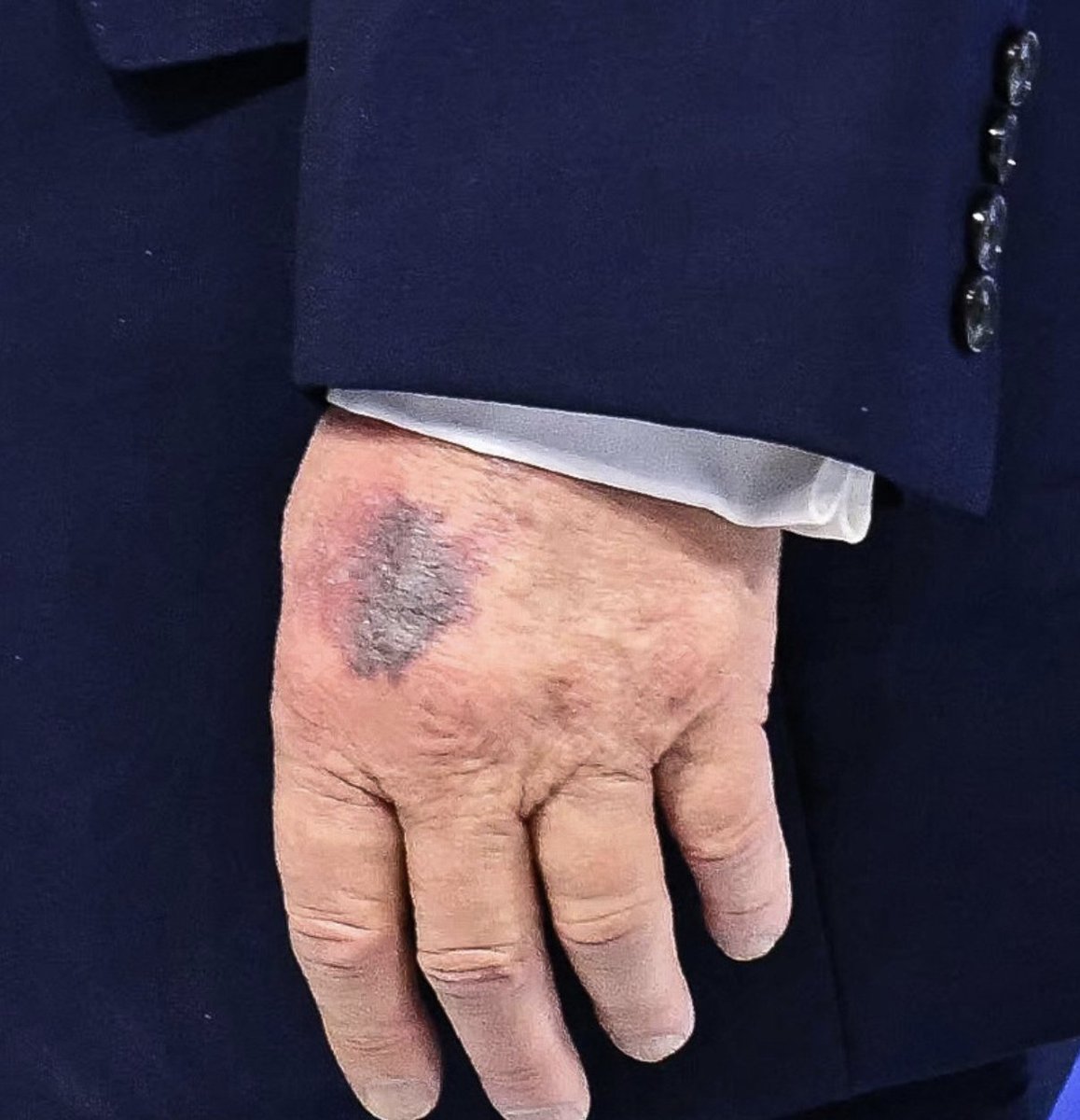 krassenstein's tweet image. BREAKING:  New Photo of Trump's LEFT hand (Not the hand he shakes with, or the one that is usually bruised) TODAY at Davos: