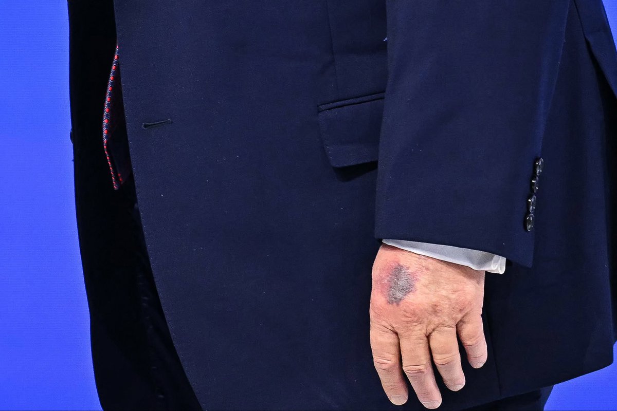 AlertaMundoNews's tweet photo. 🇺🇸 | El presidente estadounidense, Donald Trump, fue visto hoy con un moretón visible en su mano. https://t.co/1Mpr8rcjbN