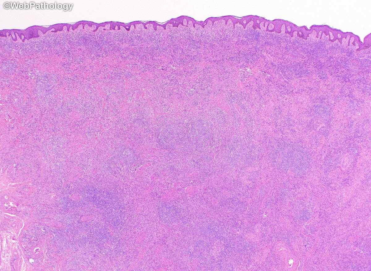 WebPathology's tweet image. Adult male with a large ulcerated and indurated lesion on foreskin. What would you do next? Additional images and diagnosis will be posted later. #gupath