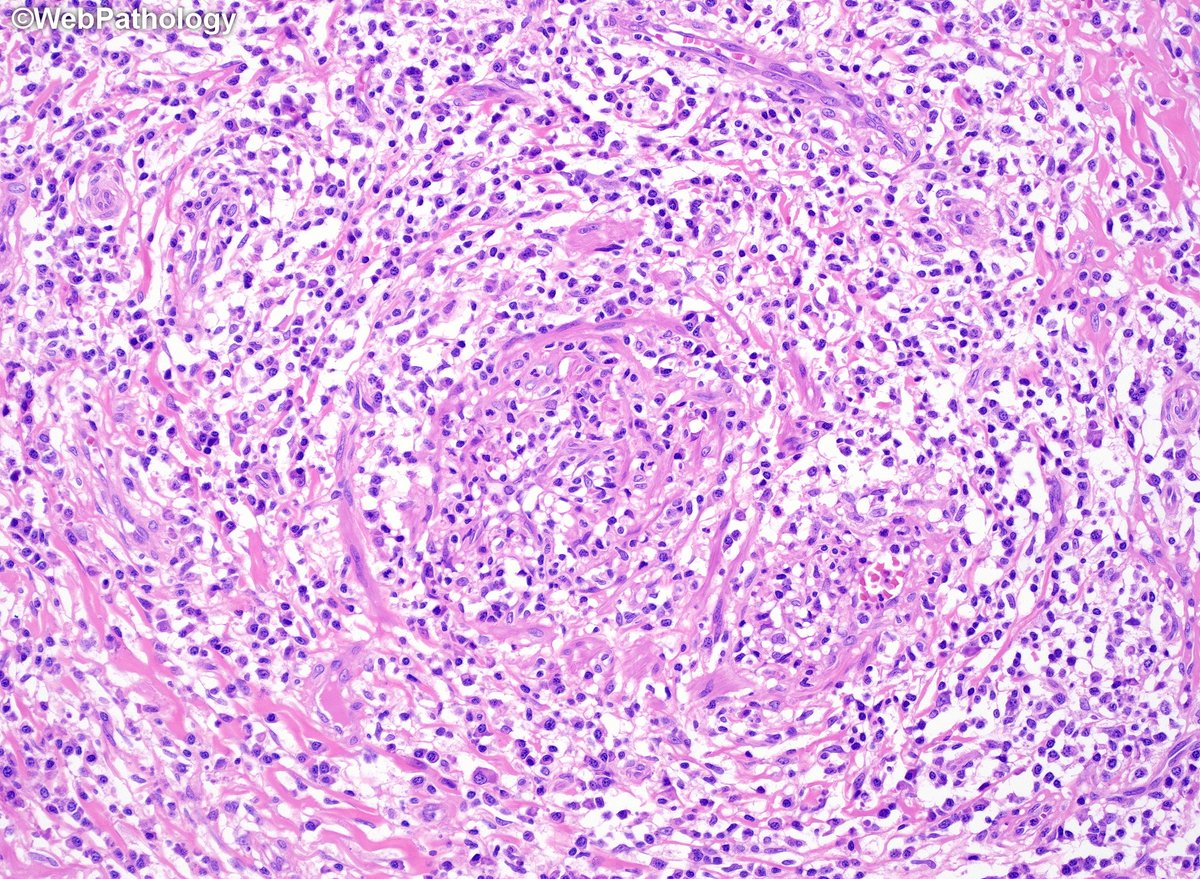 WebPathology's tweet image. Adult male with a large ulcerated and indurated lesion on foreskin. What would you do next? Additional images and diagnosis will be posted later. #gupath