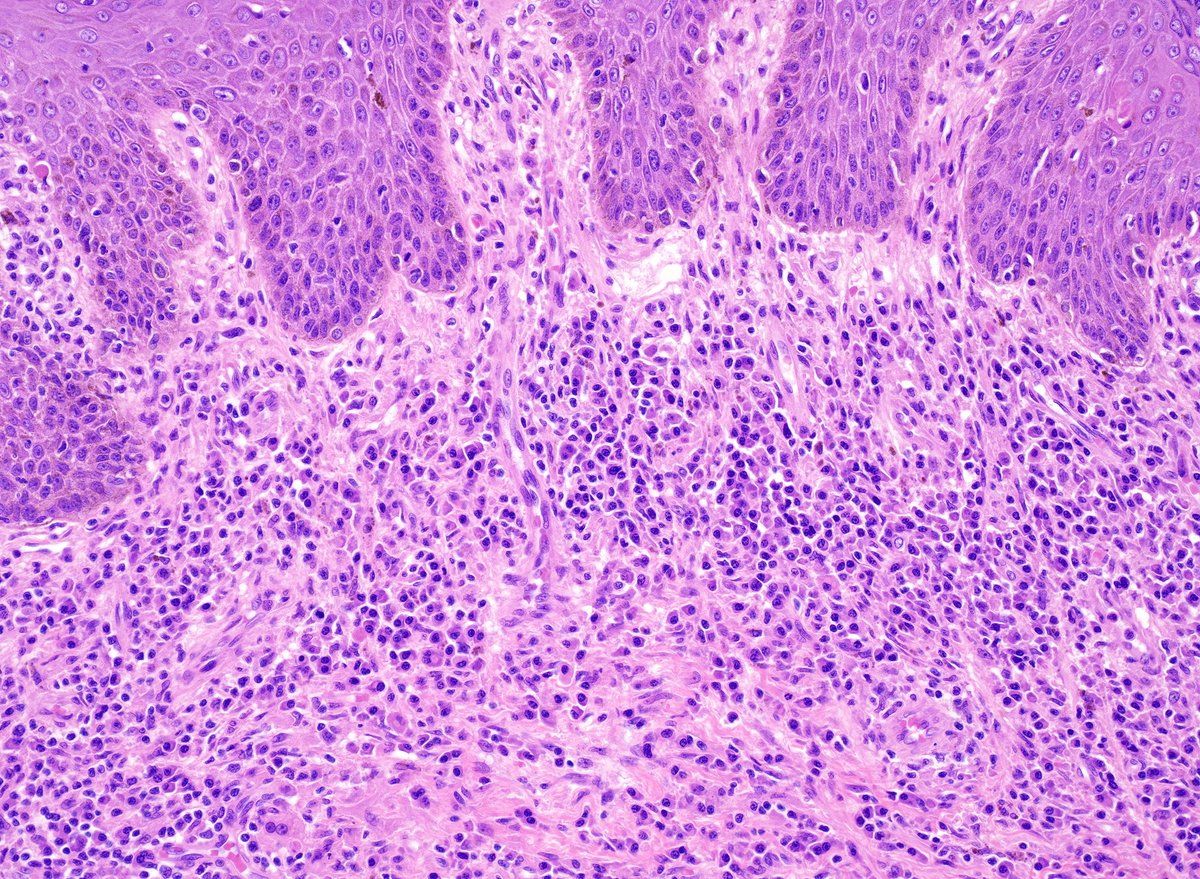 WebPathology's tweet image. Adult male with a large ulcerated and indurated lesion on foreskin. What would you do next? Additional images and diagnosis will be posted later. #gupath