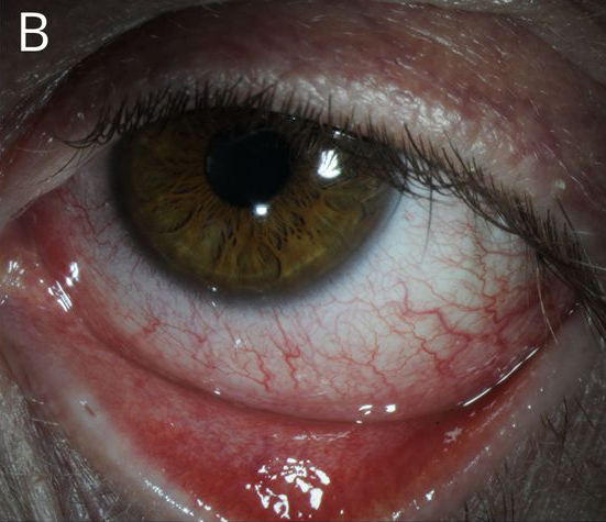 revoptom's tweet photo. Dupilumab Increases Risk of Conjunctivitis, Blepharitis in Children
This population may be vulnerable to heightened immune responses and immature goblet cells caused by IL-4 suppression.
https://t.co/OHtRnqPT4S
#dupixent #optometry #eyecare https://t.co/bvjQOKZcp1