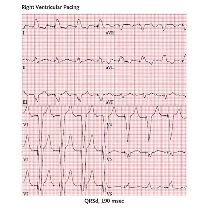 An ECG of right ventricular pacing with a paced QRS duration (QRSd) of 190 msec.