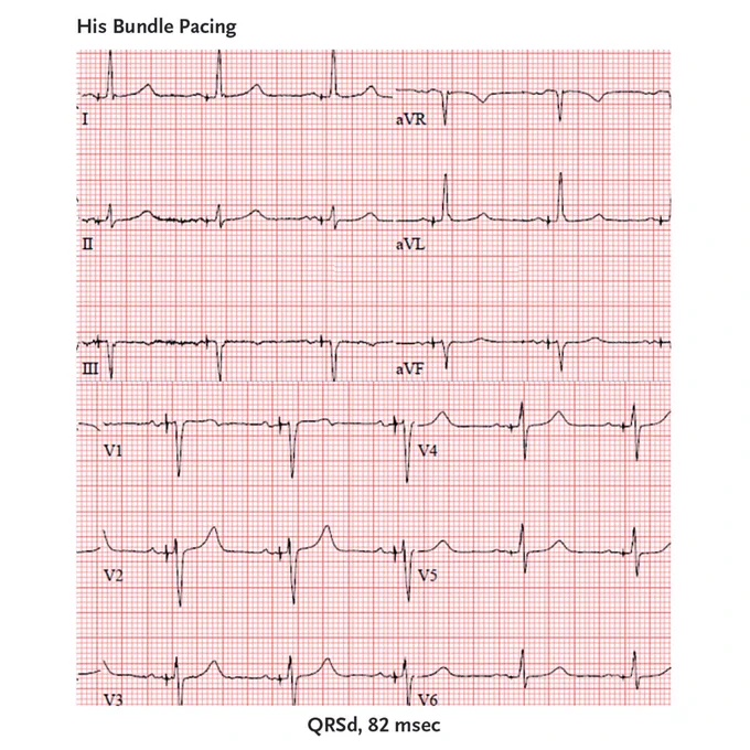 An ECG of His bundle pacing with a paced QRSd of 82 msec.