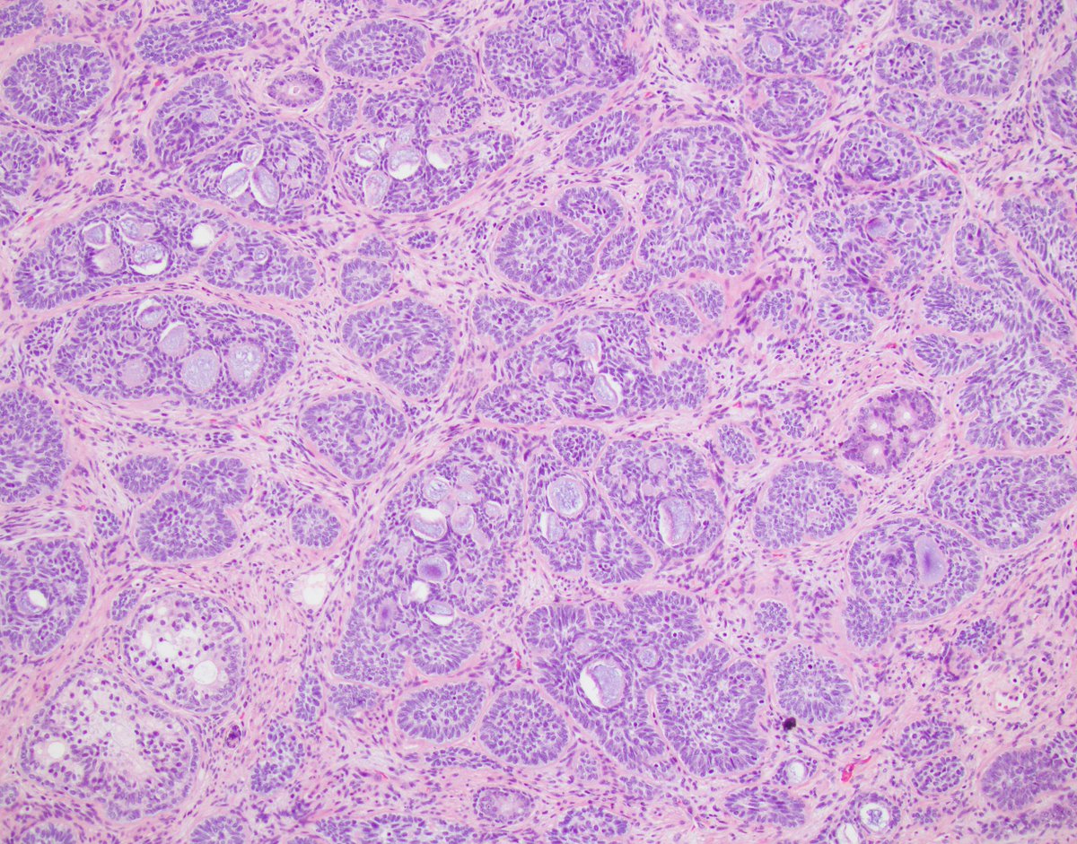 LaraHarikMD's tweet image. Unusual case on TURP
(stain is NKX3.1)

Diagnosis in the comment 👇

#gupath #pathology #pathres #raretumor