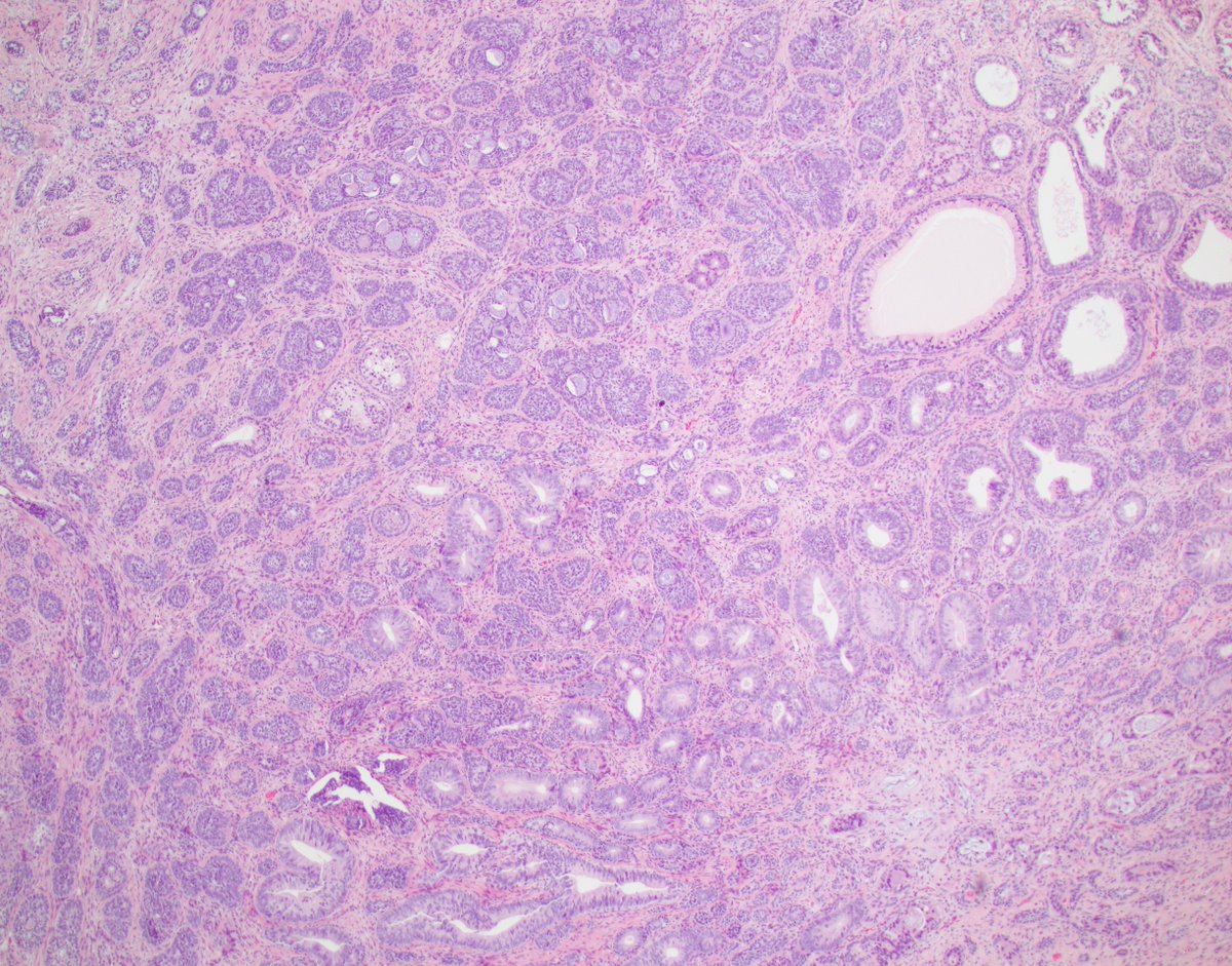 LaraHarikMD's tweet image. Unusual case on TURP
(stain is NKX3.1)

Diagnosis in the comment 👇

#gupath #pathology #pathres #raretumor