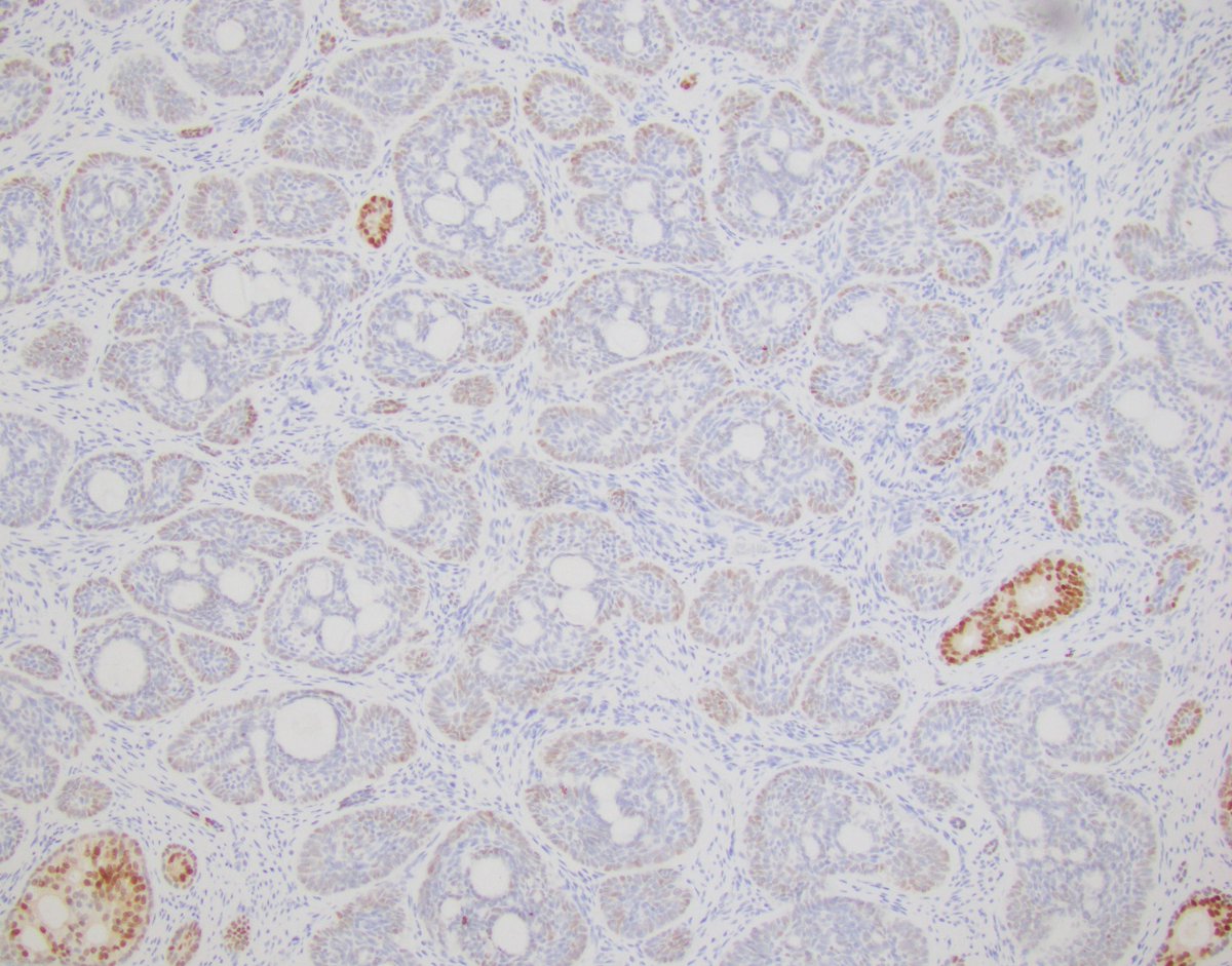 LaraHarikMD's tweet image. Unusual case on TURP
(stain is NKX3.1)

Diagnosis in the comment 👇

#gupath #pathology #pathres #raretumor
