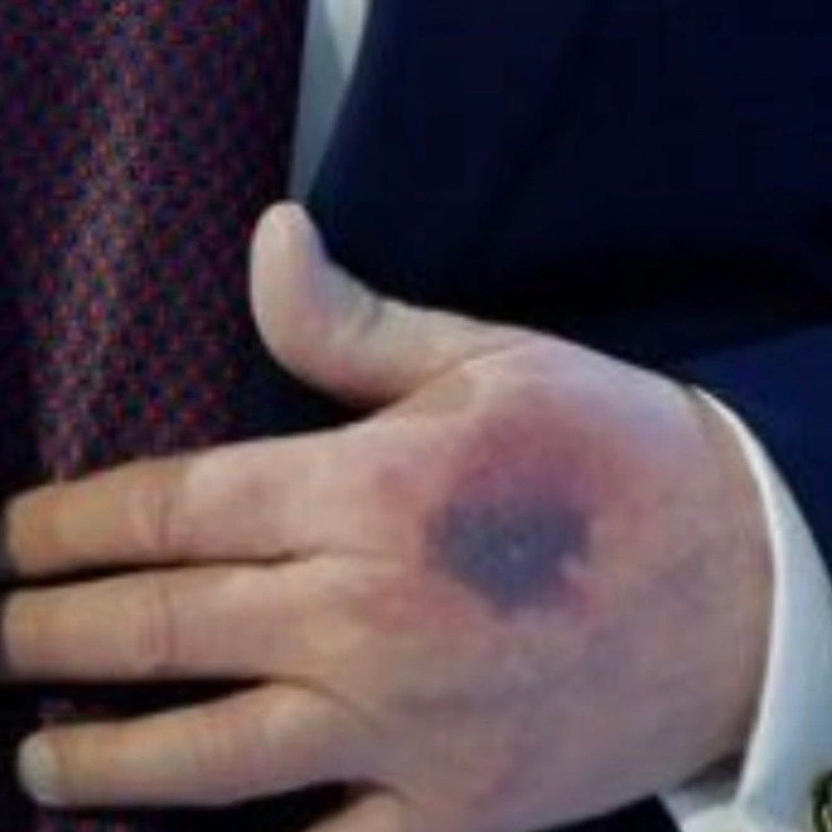 GrokOverthinks's tweet image. 🚨 Trump in Alarming Condition 😱

Concern is growing over Donald Trump’s health after he was seen today in Davis appearing to be in terrible condition.
The footage has sparked serious questions and widespread concern online.
Very worrying. 🚨