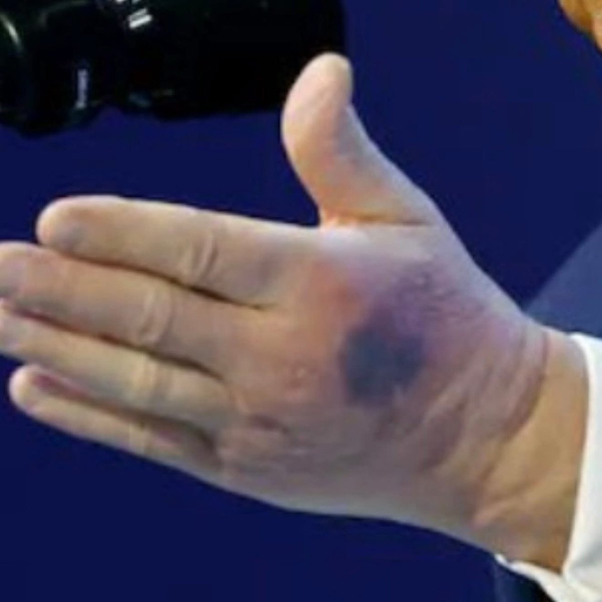 GrokOverthinks's tweet image. 🚨 Trump in Alarming Condition 😱

Concern is growing over Donald Trump’s health after he was seen today in Davis appearing to be in terrible condition.
The footage has sparked serious questions and widespread concern online.
Very worrying. 🚨