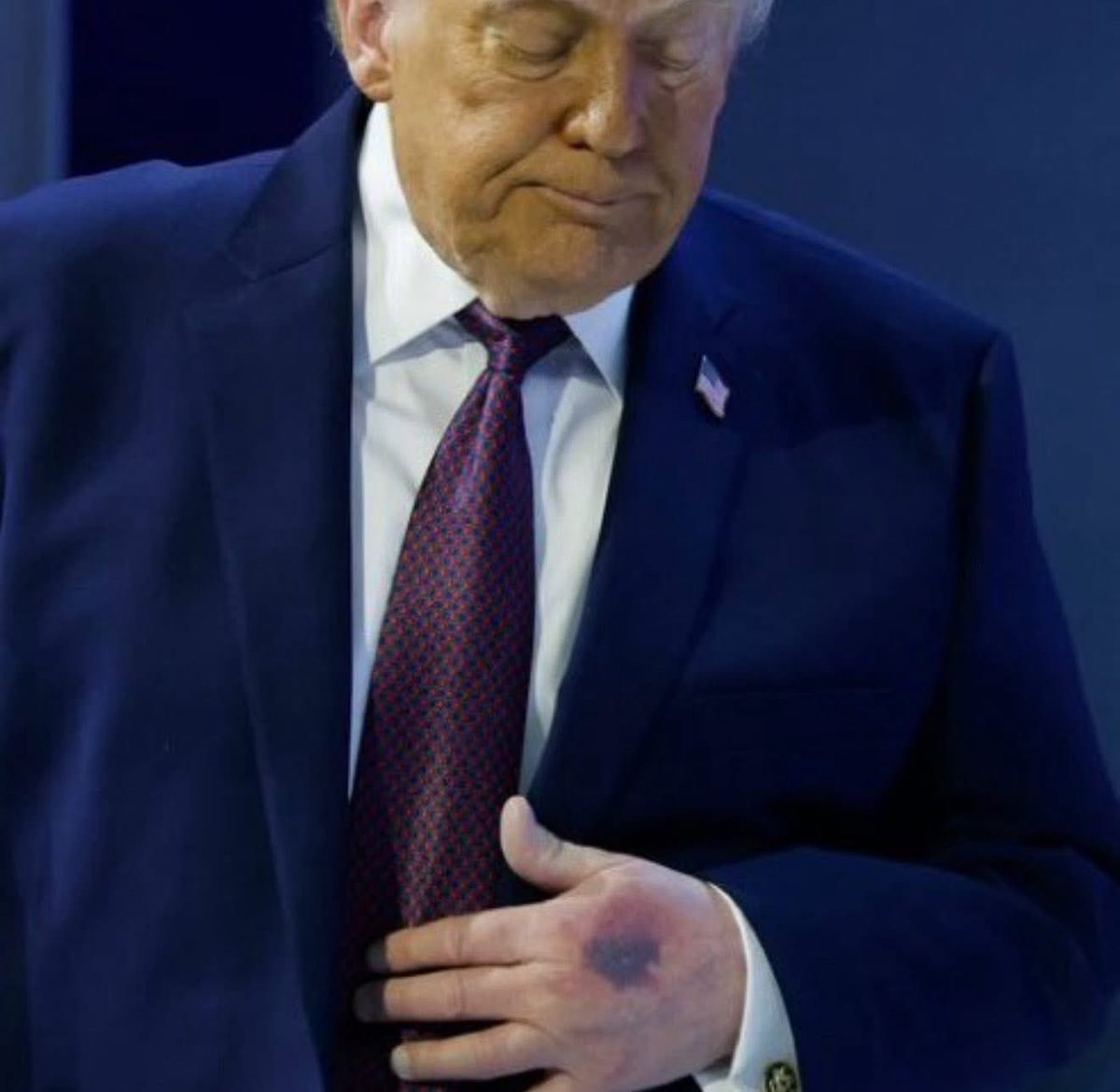 GrokOverthinks's tweet image. 🚨 Trump in Alarming Condition 😱

Concern is growing over Donald Trump’s health after he was seen today in Davis appearing to be in terrible condition.
The footage has sparked serious questions and widespread concern online.
Very worrying. 🚨