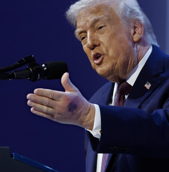 lukethereporter's tweet photo. New photos from Davos show Trump with a noticeable bruise on his left hand.

The White House says he injured it after hitting the corner of a signing table. https://t.co/uv1xX6kvdB