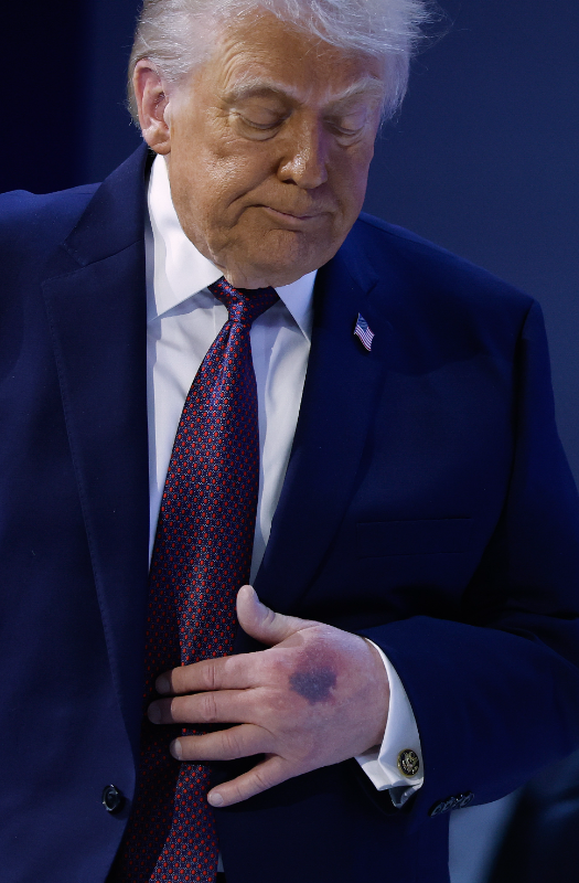 lukethereporter's tweet photo. New photos from Davos show Trump with a noticeable bruise on his left hand.

The White House says he injured it after hitting the corner of a signing table. https://t.co/uv1xX6kvdB