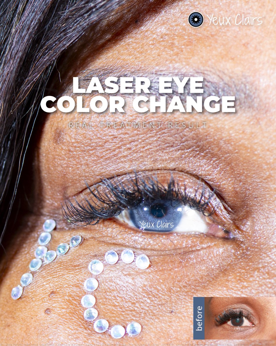Effects may include glow and constant compliments. ✨😉

More results: yeuxclairs.com/gallery
#LaserEyeColorChange #PermanentResults #SafeAndPainless