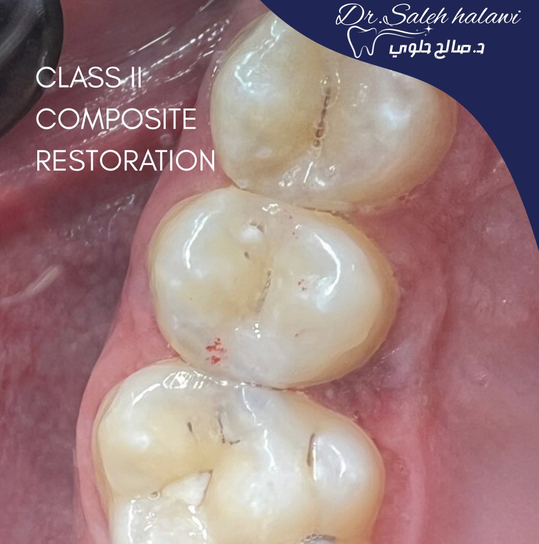 slo_s24's tweet photo. Class II composite restoration under rubber dam isolation.🫶🏻 #operative https://t.co/WQzW0zRvAc