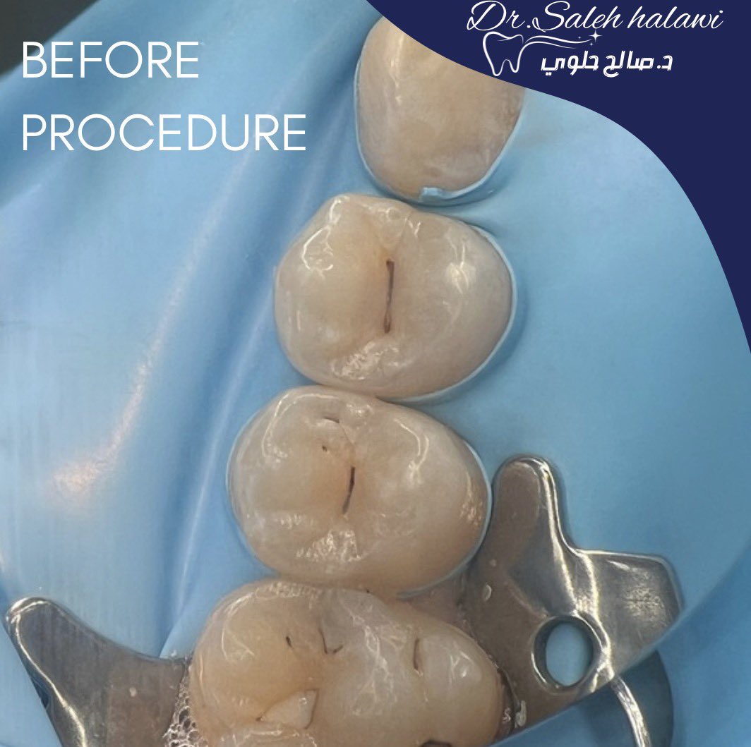 Class II composite restoration under rubber dam isolation.🫶🏻 #operative