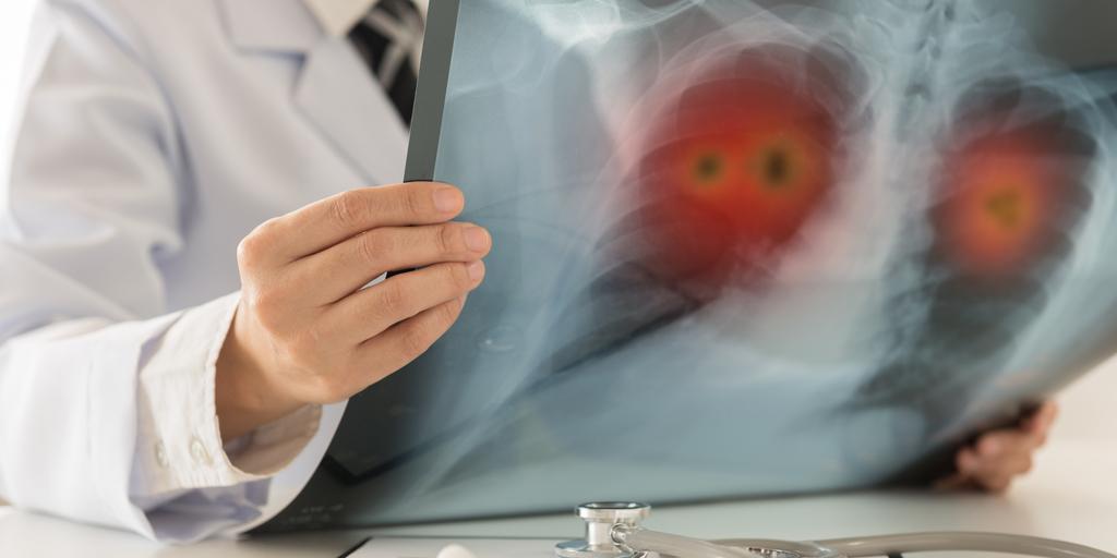 360DxNews's tweet photo. Circulating Tumor Cell Assay Finds Best Responders to Amgen's Small Cell Lung Cancer Drug https://t.co/y4Tsvmro23 https://t.co/WfpcYTdyg1
