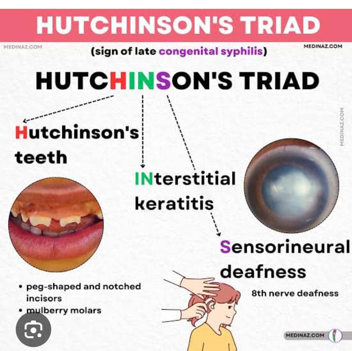 Sulphur_100's tweet photo. Day1
Hutchinson Triad are set of symptoms seen in late congenital syphillis infection and they include Hutchinson's teeth, interstitial keratitis and cranial nerve 8 deafness.
#medschoollife #medstudent #medtwitter https://t.co/Amn4yRQStl