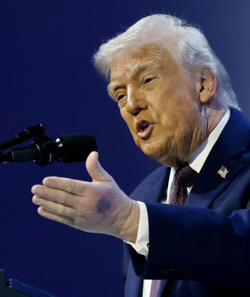 TrendxNow's tweet image. President Donald  Trump arrives at Davos with visible bruising on his left hand, following months of similar marks on his right. 
The White House blames 'constant handshakes,'
 Shaking hands or a health red flag? 🤚⚖️ #TrumpHealth #Davos2026 #Breaking