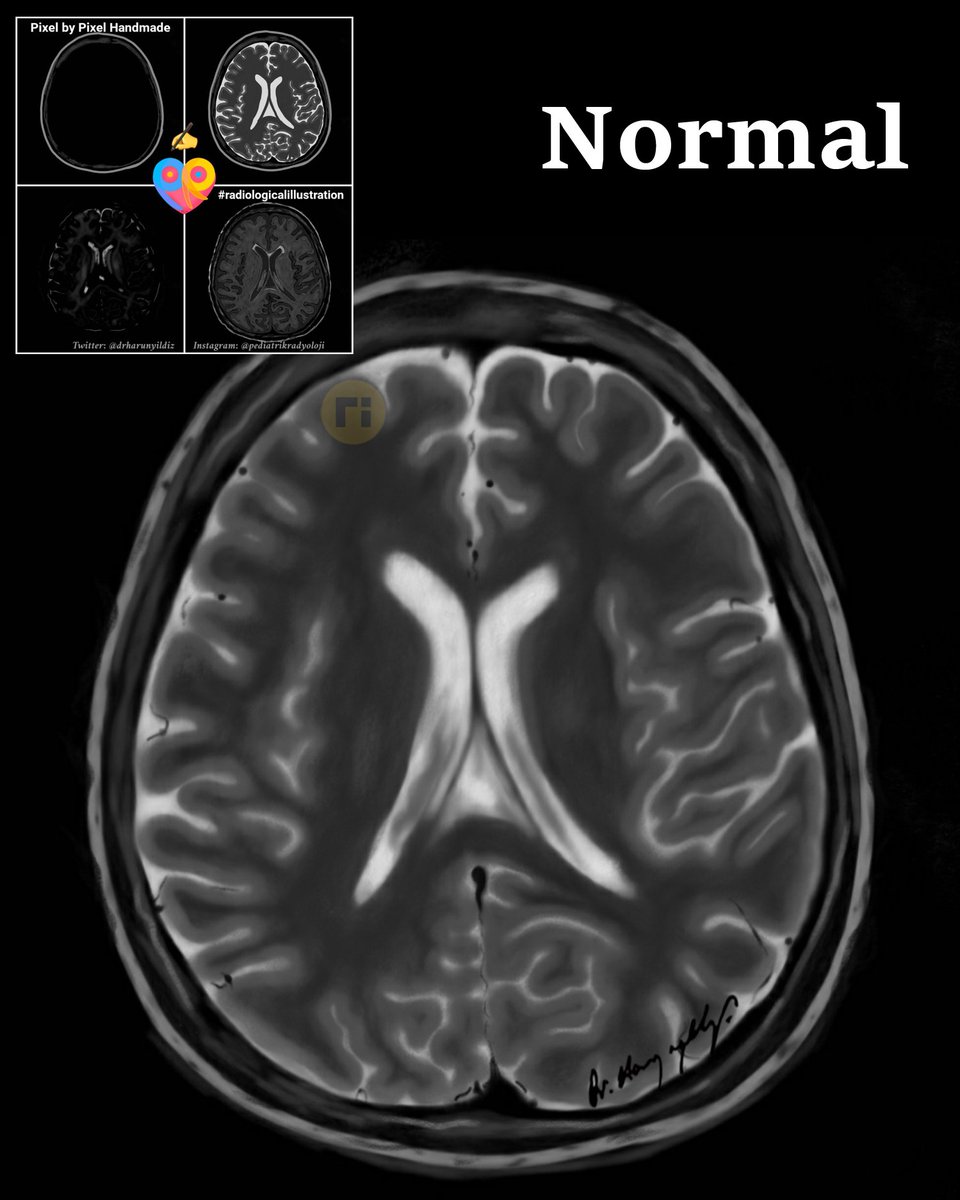 Bannayan–Riley–Ruvalcaba Syndrome

doi.org/10.1007/s12672…
dx.doi.org/10.3174/ajnr.A…

#radiologicalillustration
pixel by pixel handmade!