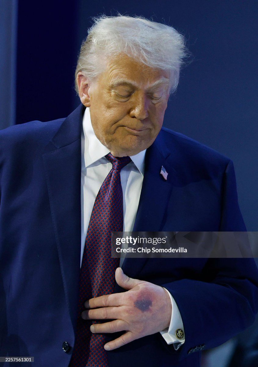 ElNecio_Cuba's tweet image. 🇺🇸 La foto de la mano de Trump en Davos y su excesivo maquillaje muestra lo que es un secreto a voces y sobre eso los medios de EEUU insisten: la salud de Trump puede estar deteriorada. 

¿Qué creen los médicos?